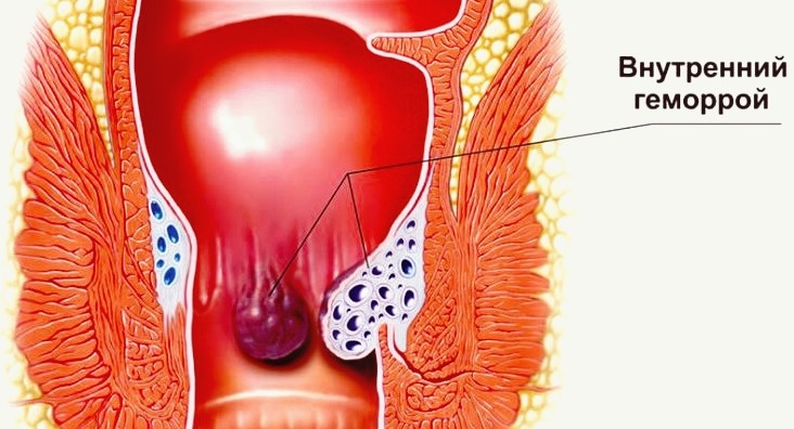 У меня был такой геморрой