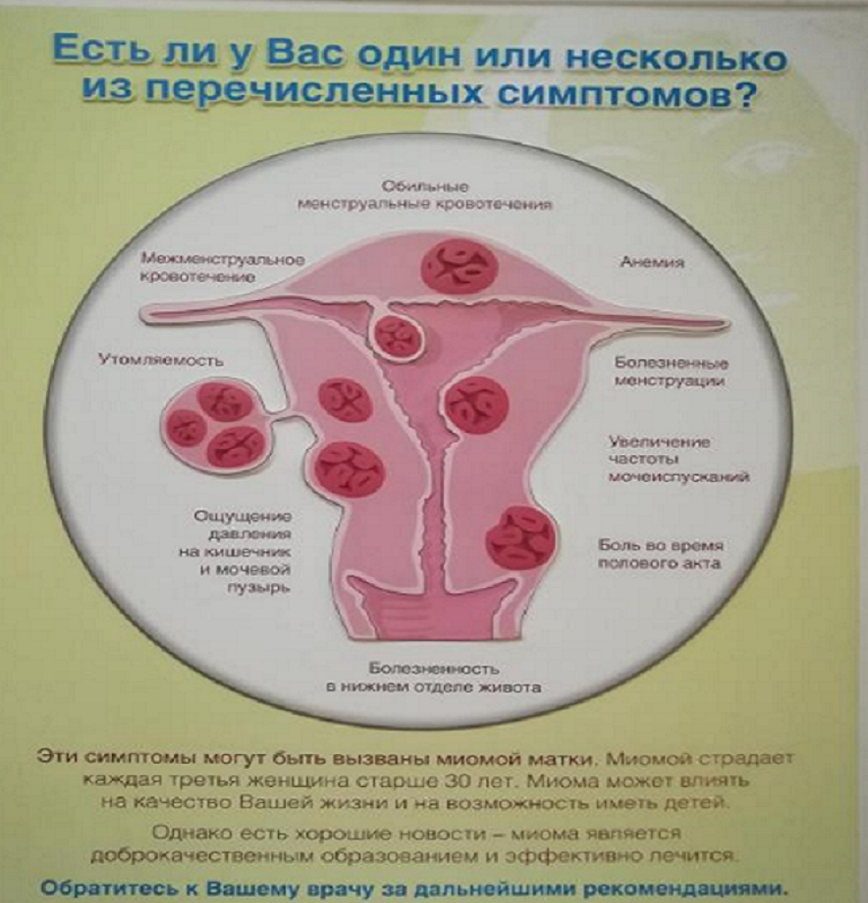 Миома 16 недель размеры в сантиметрах фото