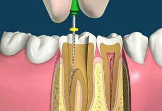Как Убить Нерв В Зубе В Домашних Условиях