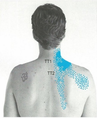 Зоны для проработки мышцы поднимающей лопатку