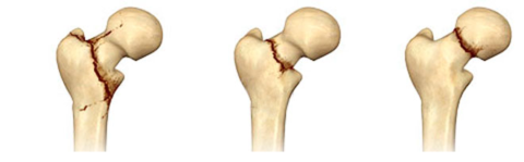  Некоторые виды сломов в шейке бедра