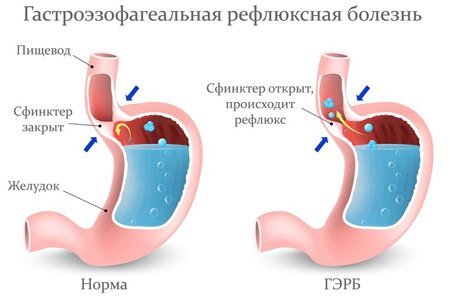 Почему после еды возникает отрыжка у взрослых: причины и методы лечения