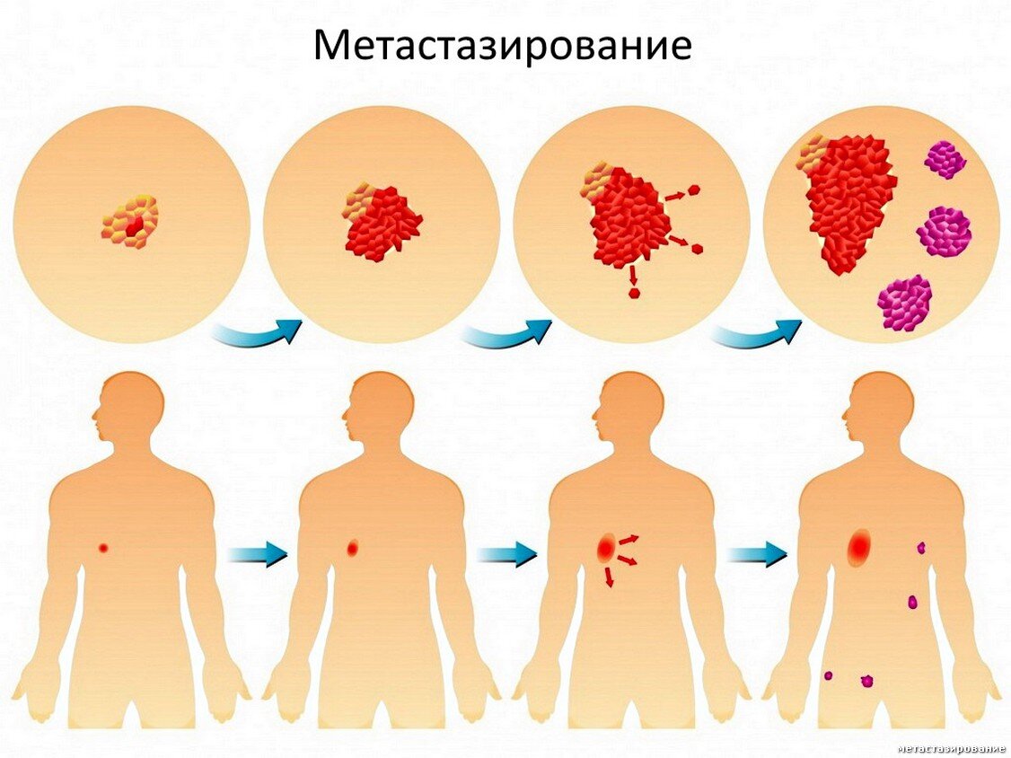 Онкология в картинках