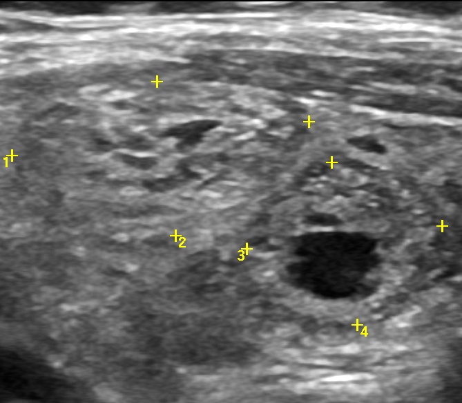 Фото узи щитовидной железы с узлом
