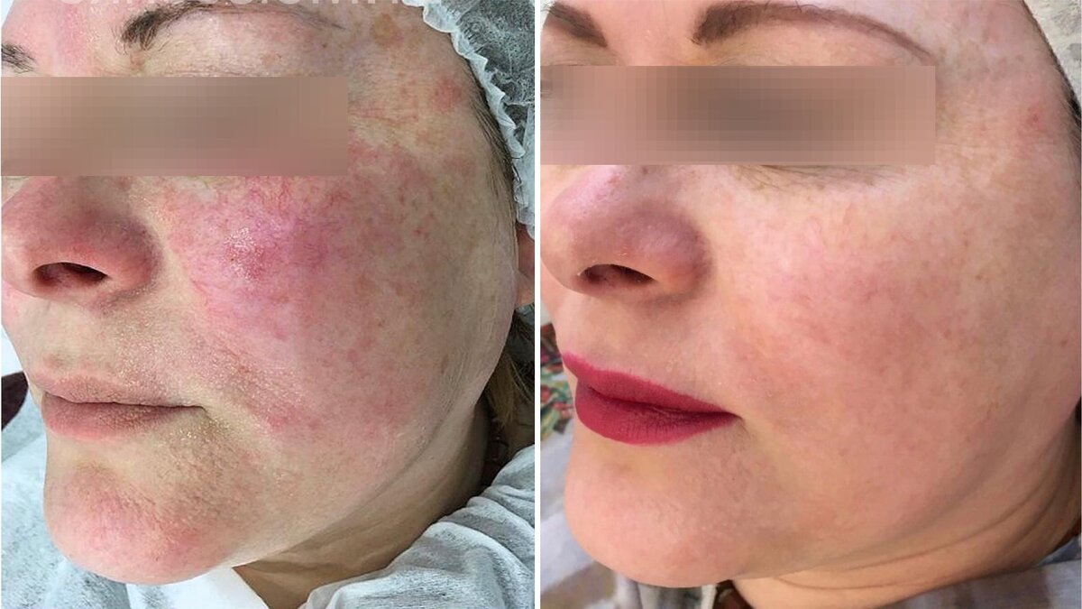 Фото "до" и "после" процедуры фотоомоложения на аппарате Alma Harmony.