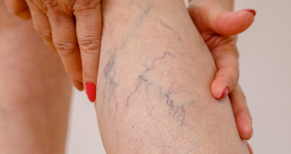 Сосудистая сеточка на ногах. Фото из открытых источников