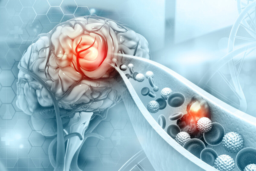 Криптогенный инсульт. Часть 4: антифосфолипидный синдром и рак