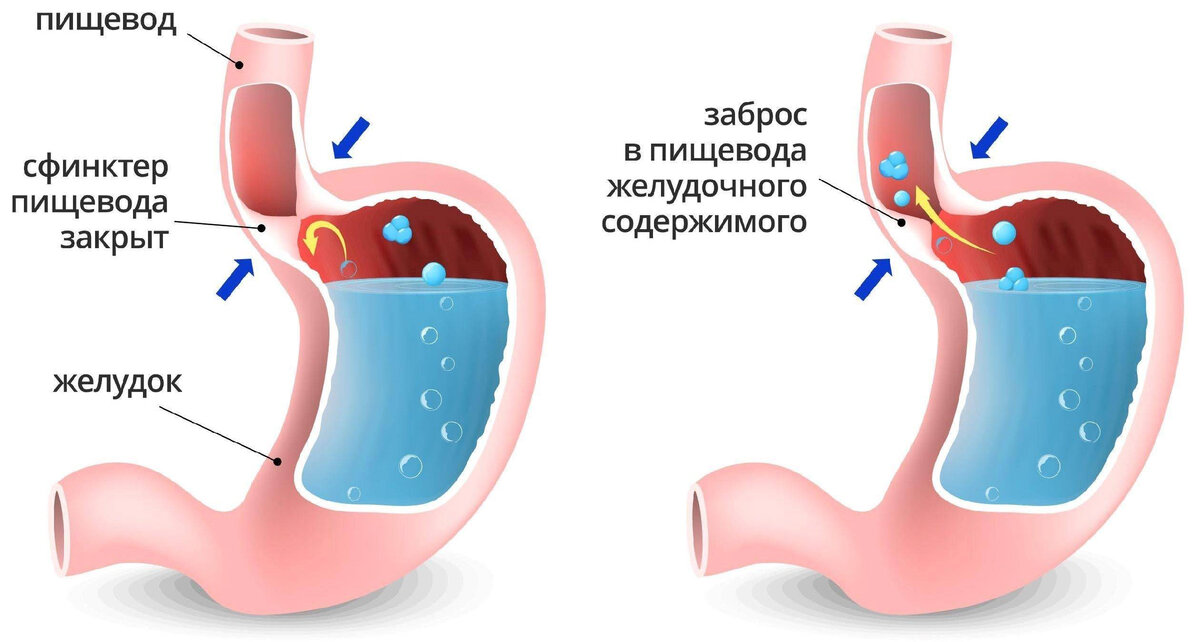 Так выглядит рефлюкс-эзофагит. Фото из открытых источников