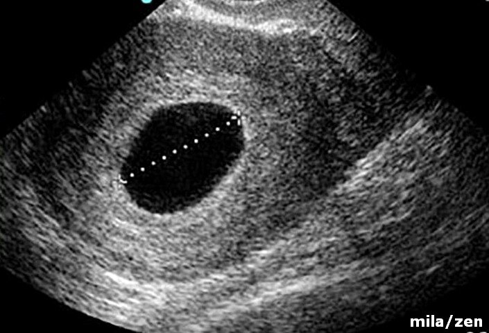 Мог ли врач узи перепутать миому с беременностью: 🍼 гинекология и беременность