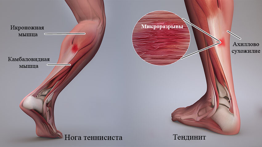 Икры на ногах раздваивается