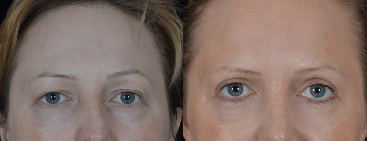 Пластика верхних век и липофилинг нижнего и верхнего века. Фото с сайта Д.Р. Гришкяна. Имеются противопоказания, требуется консультация специалиста