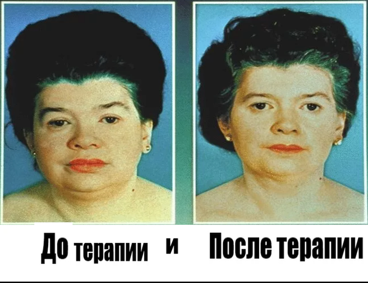Гипотиреоз фото женщин. Патология щитовидной железы. Гипотиреоз фото женщин. Лицо женщины с гипотиреозом. Гипертиреоз микседема.