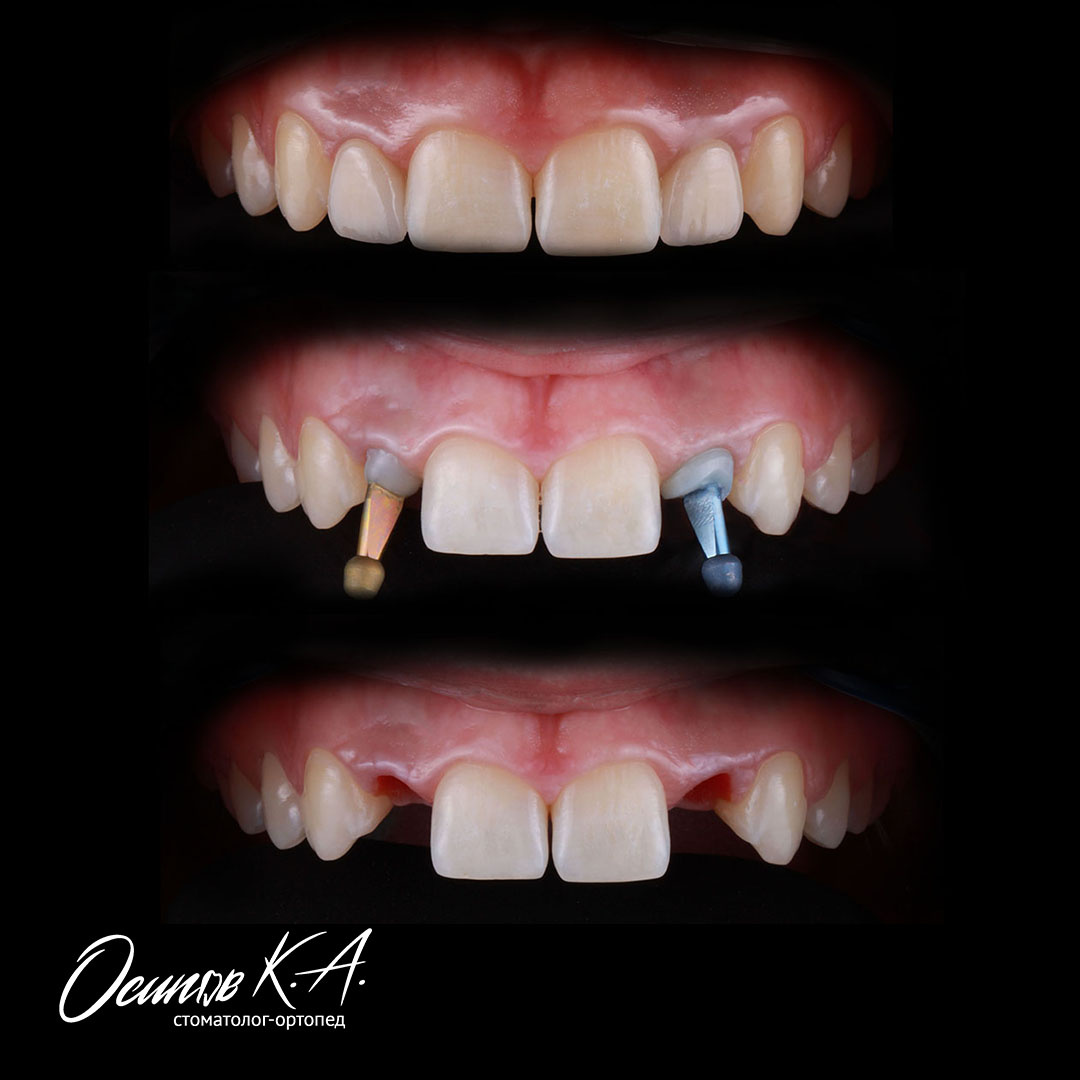 На фото работа минимум 4х специалистов: Стоматолога-хирурга, стоматолога-ортодонта, стоматолога-ортопеда, зубного техника.