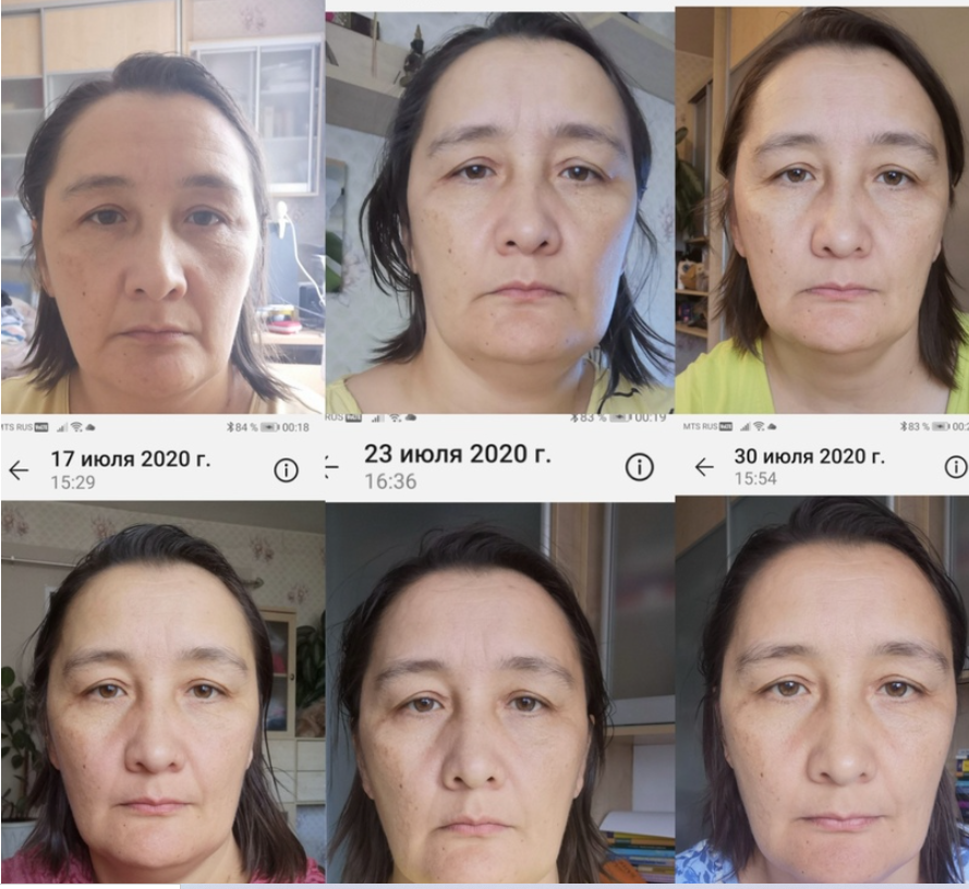 На этом фото видно как меняется форма лица по мере устранения последствий ковида. Фотографии моей пациентки. Используется по разрешению.