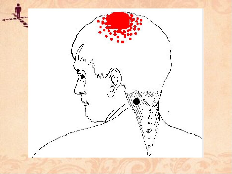 Голова левая сторона затылок. Дискомфорт в теменной части головы. Точка на макушке головы. Головные боли по точкам на голове.