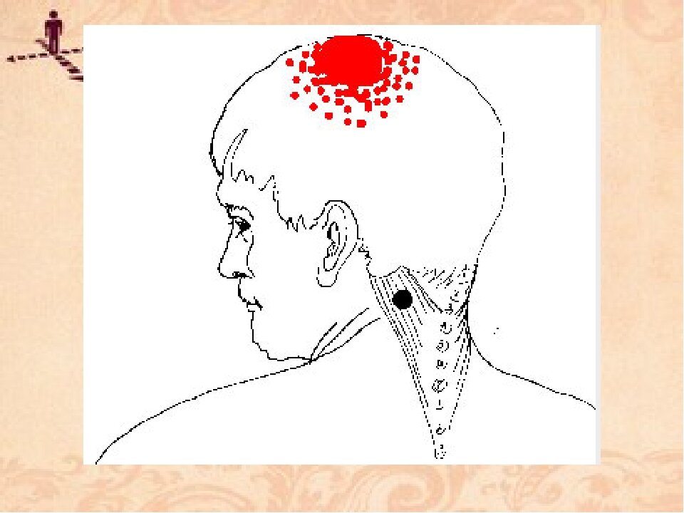Левая часть затылка. Дискомфорт в теменной части головы. Точка на макушке головы. Головные боли по точкам на голове.