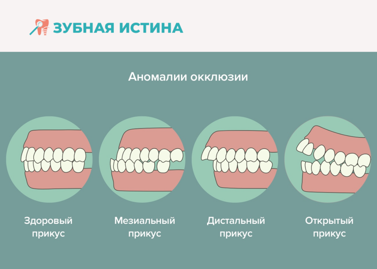 Как правильно исправить прикус