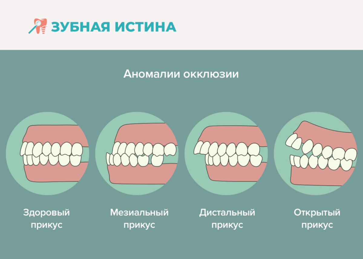 Какой правильный прикус у человека картинки