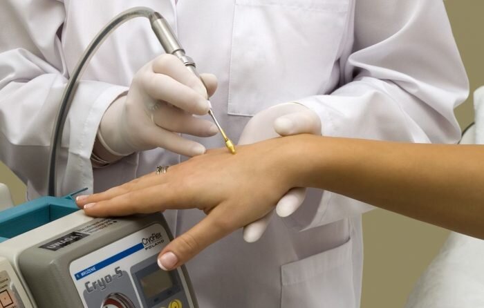 Метод удаления бородавок жидким азотом основан на воздействии низких температур