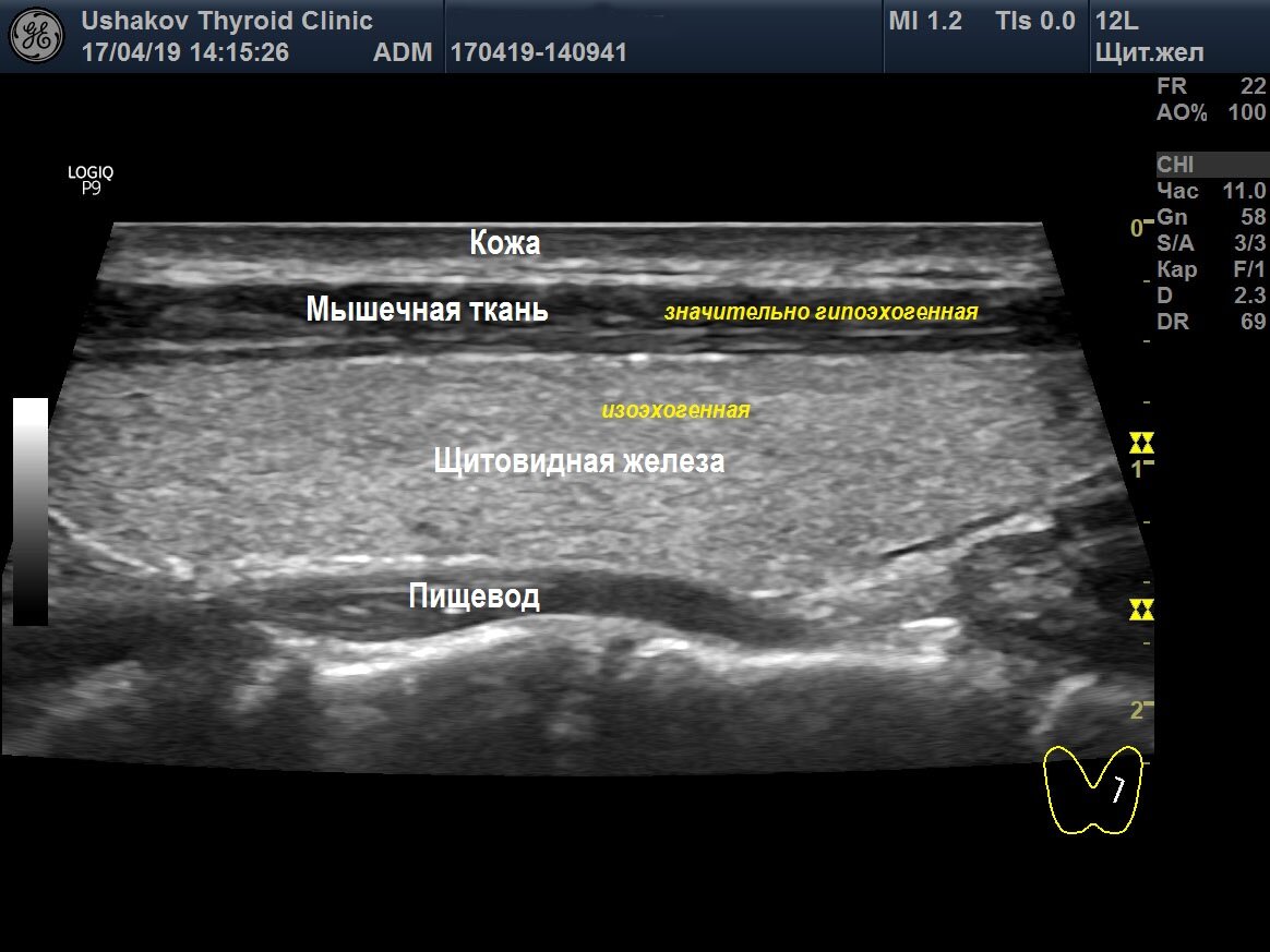 Солидный узел щитовидной. Изоэхогенный узел щитовидной железы на УЗИ. Изоэхогенное образование щитовидной железы УЗИ. Нижний полюс щитовидной железы на УЗИ. Изоэхогенный узел щитовидной железы что это такое.