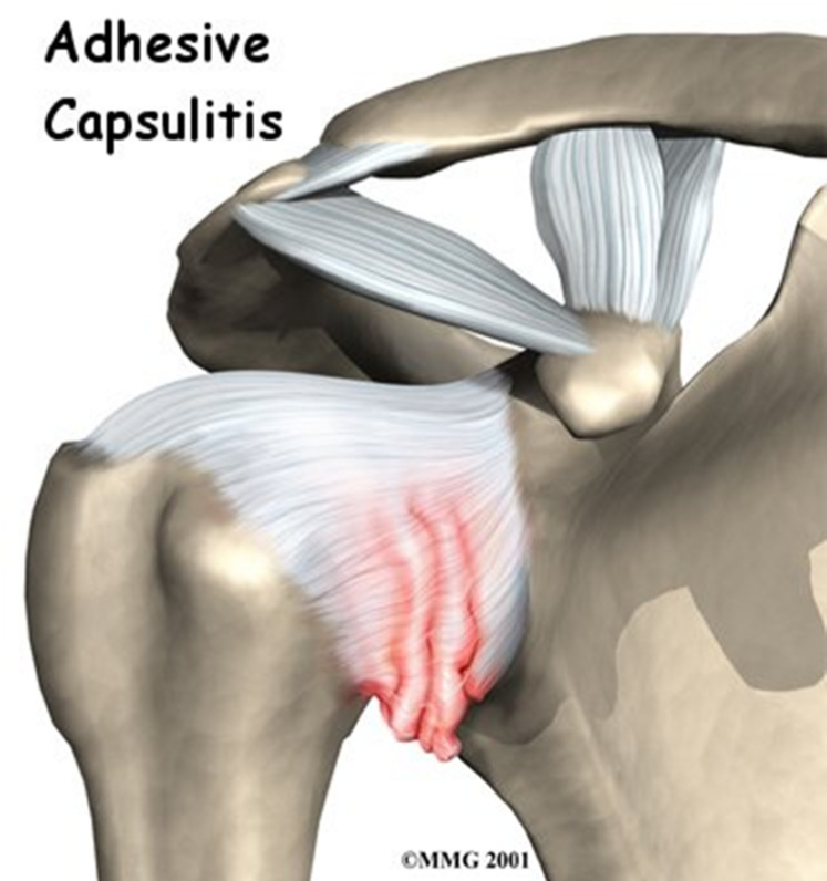 Боли при плечелопаточном периартрите. Капсулит тазобедренного сустава. Адгезивный капсулит тазобедренного сустава. Капсулит коленного сустава. Плечелопаточный периартрит.