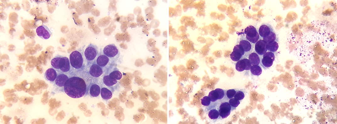 На фото 2 - клетки, крупнее нормальных тиреоцитов, образуют фолликулярные структуры, ядра клеток отличаются по размерами (ядерный полиморфизм). Ясно, что это опухоль, но клетки вцелом выглядят относительно доброкачественно. Вместе с тем, это оказался инвазивный фолликулярный рак и метастазами в регионарные лимфатические узлы. Хирурги шли на аденому, первоначально удалили долю с перешейком. А по результатам - проведена повторная операция с удалением всей щитовидной железы, лимфатических узлов и после - лечение радиоактивным йодом.