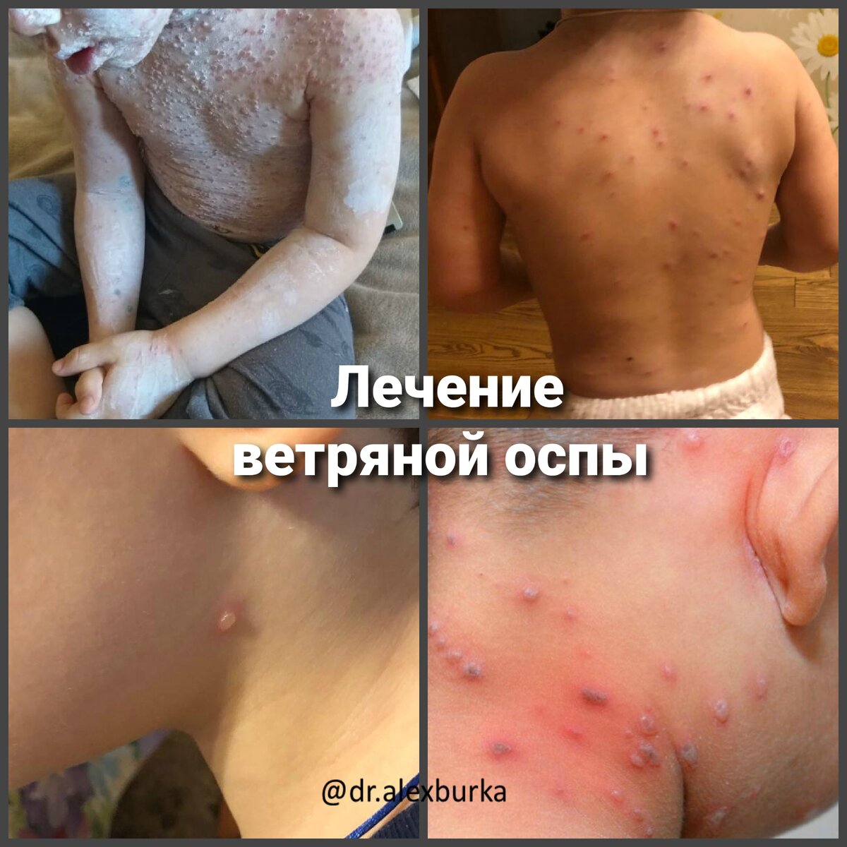 Сыпь при ветряной оспе 