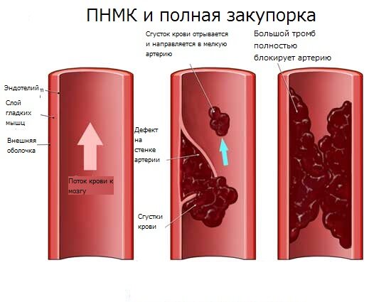 Укрепление стенок вен