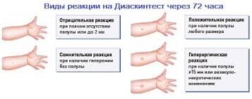 В первый день может появиться незначительное изменение цвета кожных покровов в месте введения препарата – от бледно-красного до синеватого. Переживать не стоит, если при этом никакой припухлости, отечности иди уплотнения не появляется. Скорее всего, с ребенком все нормально, просто медсестра не совсем удачно провела тест. Если при введении препарата был поврежден кровеносный сосуд, это проявляется как небольшое подкожное кровоизлияние.