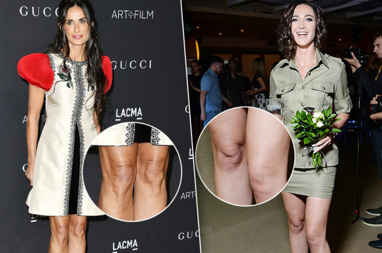 Она не смогла скрыть очевидный дефект