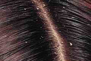Перхоть и выпадение волос: причины и лечение недуга