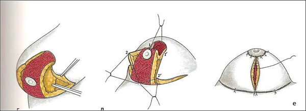 рис. 1. Схема проведения Т-образной мастопексии.