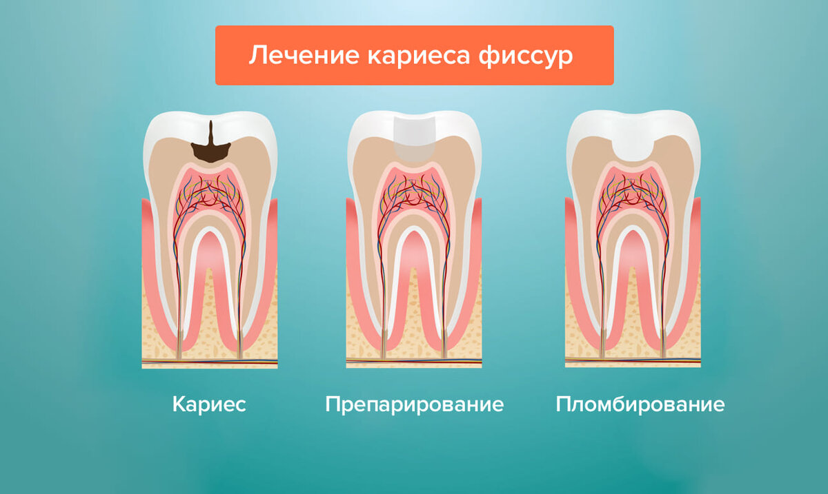 Пульпит детская стоматология