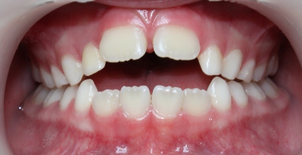 Открытый прикус. Передние зубки не смыкаются. Затруднено откусывание пищи.