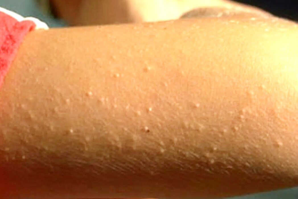 Как убрать «гусиную кожу»: причины появления, витамины и уходовая косметика от гусиной кожи