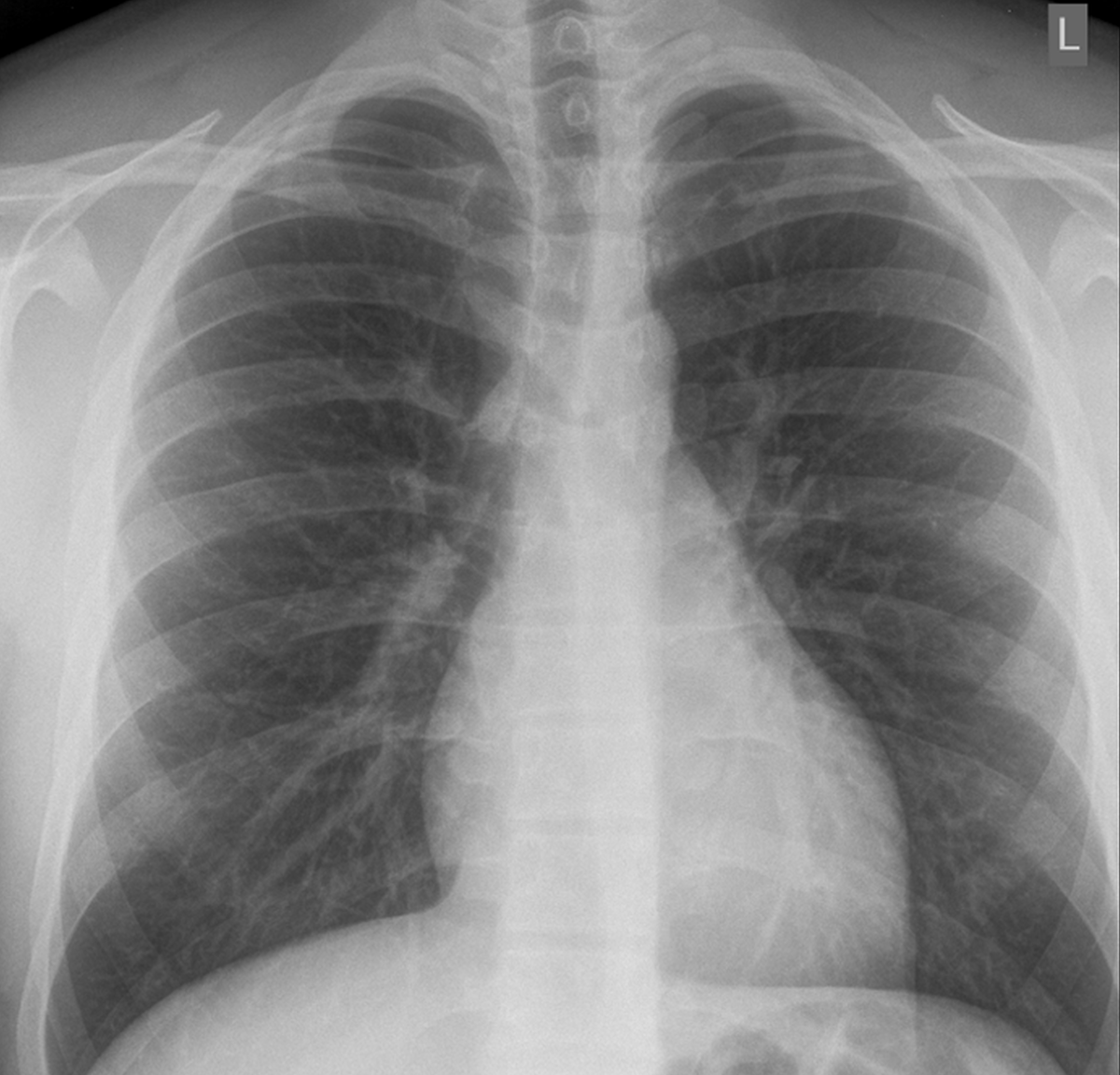 Рис. 1. На исходной рентгенограмме грудной клетки нет снижения прозрачности; типичных признаков пневмонии COVID-19 не обнаружено.