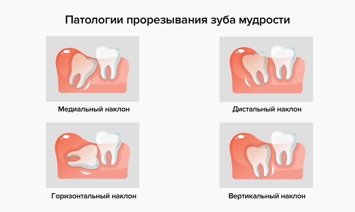 Зуб мудрости на схеме зубов