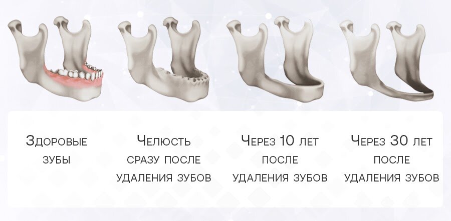 Без жевательной нагрузки губчатая костная ткань челюстей рассасывается – кость теряет объем, изменяется ее рельеф. Фотоколлаж: Smile-at-Once.ru.