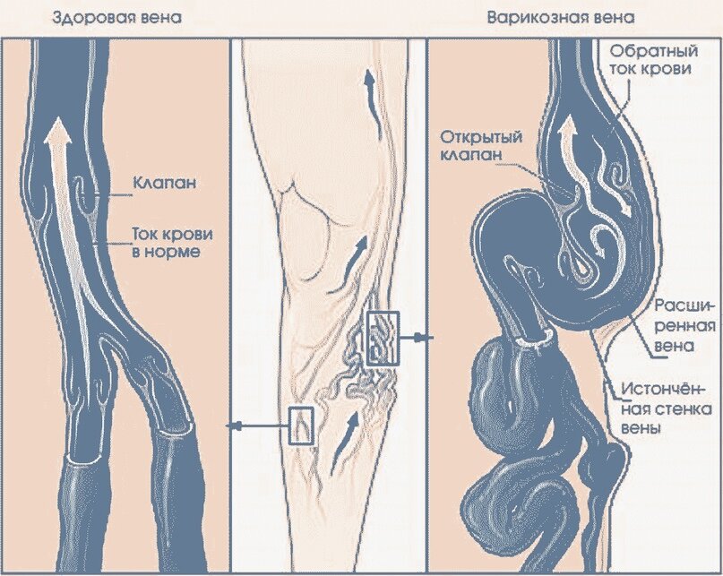 Вен пей. Нормальная и варикозная Вена. Операция варикозное расширение. Операции при варикозной болезни вен.