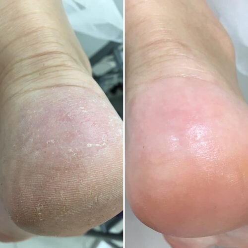 Причины хронической сухости кожи стоп