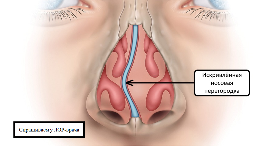 Операция при искривлении перегородки носа