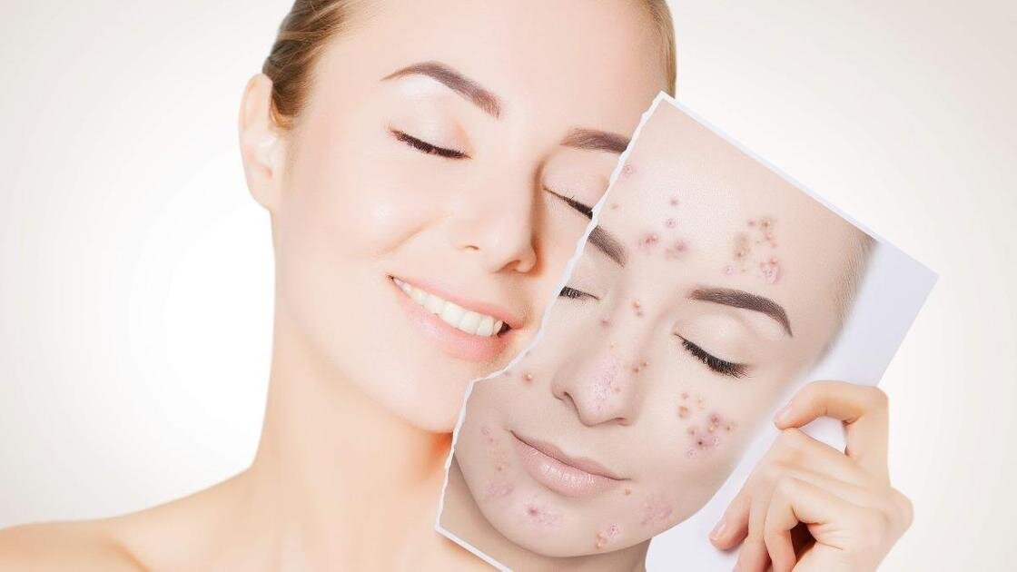 Причины появления прыщей 