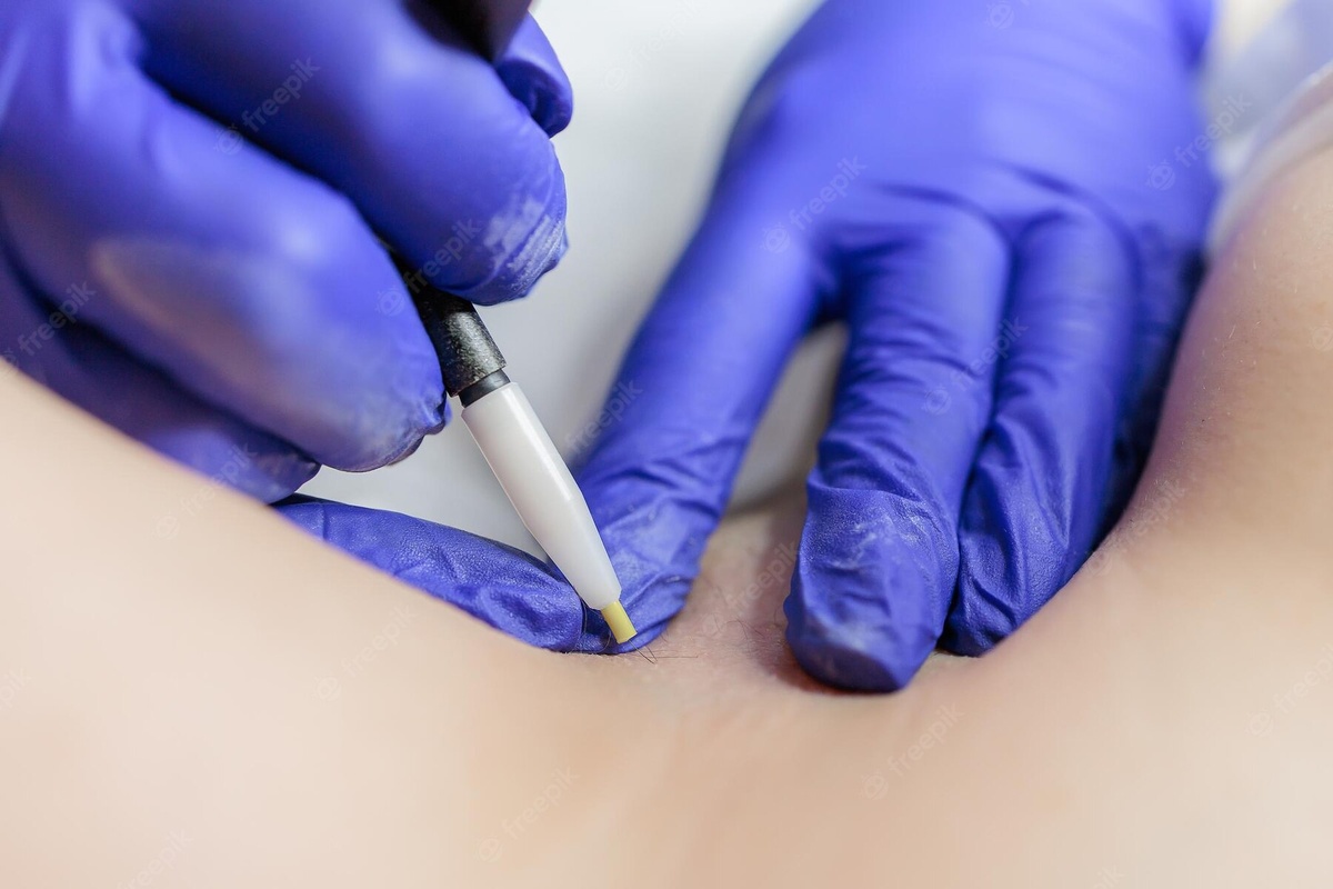 Электроэпиляция