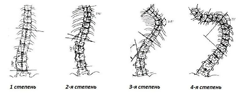 Степени сколиоза по Дж. Коббу