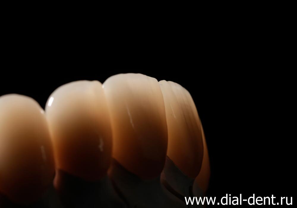 керамические зубные коронки