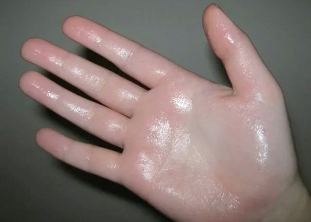 Гипергидроз