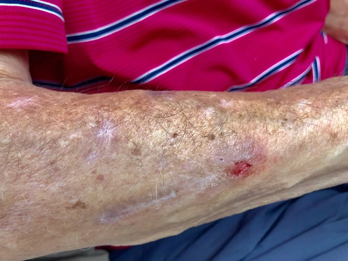 так выглядит заразившийся болезнью Моргеллонов 