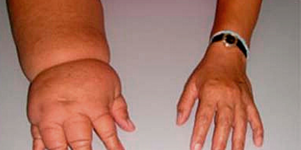 Лимфостаз.  Блок лимфатических сосудов.