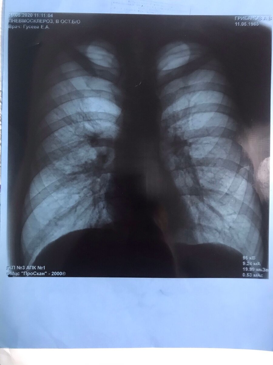 Мой снимок за пол года до обнаружения туберкулеза. Врачи говорят что на нем все хорошо... может найдется читатель, который скажет обратное... милости прошу в комментарии.