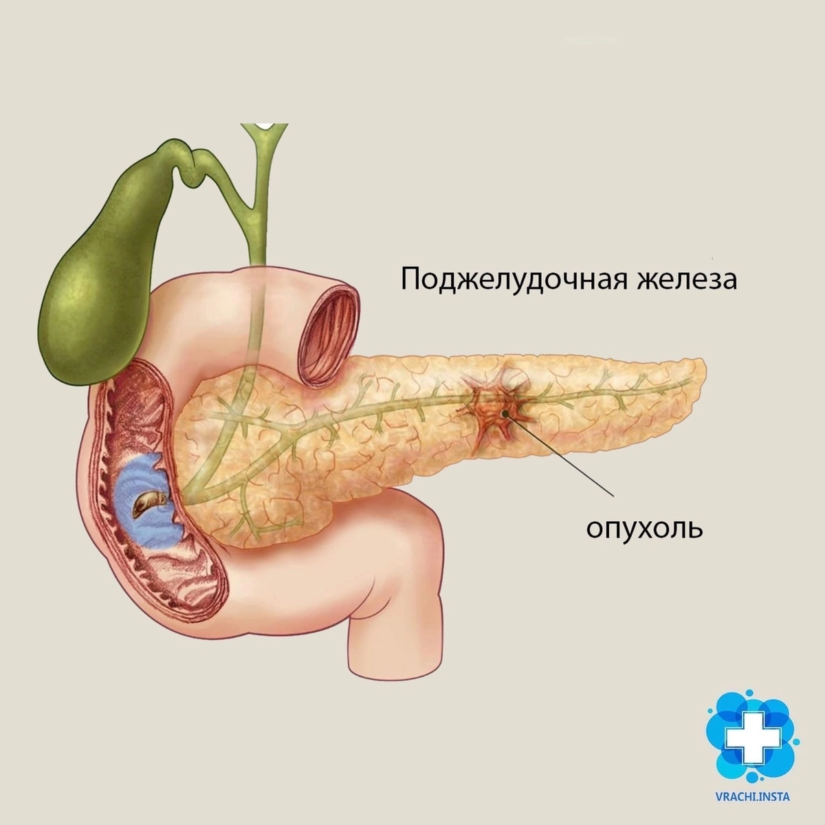 Рак поджелудочной железы картинка